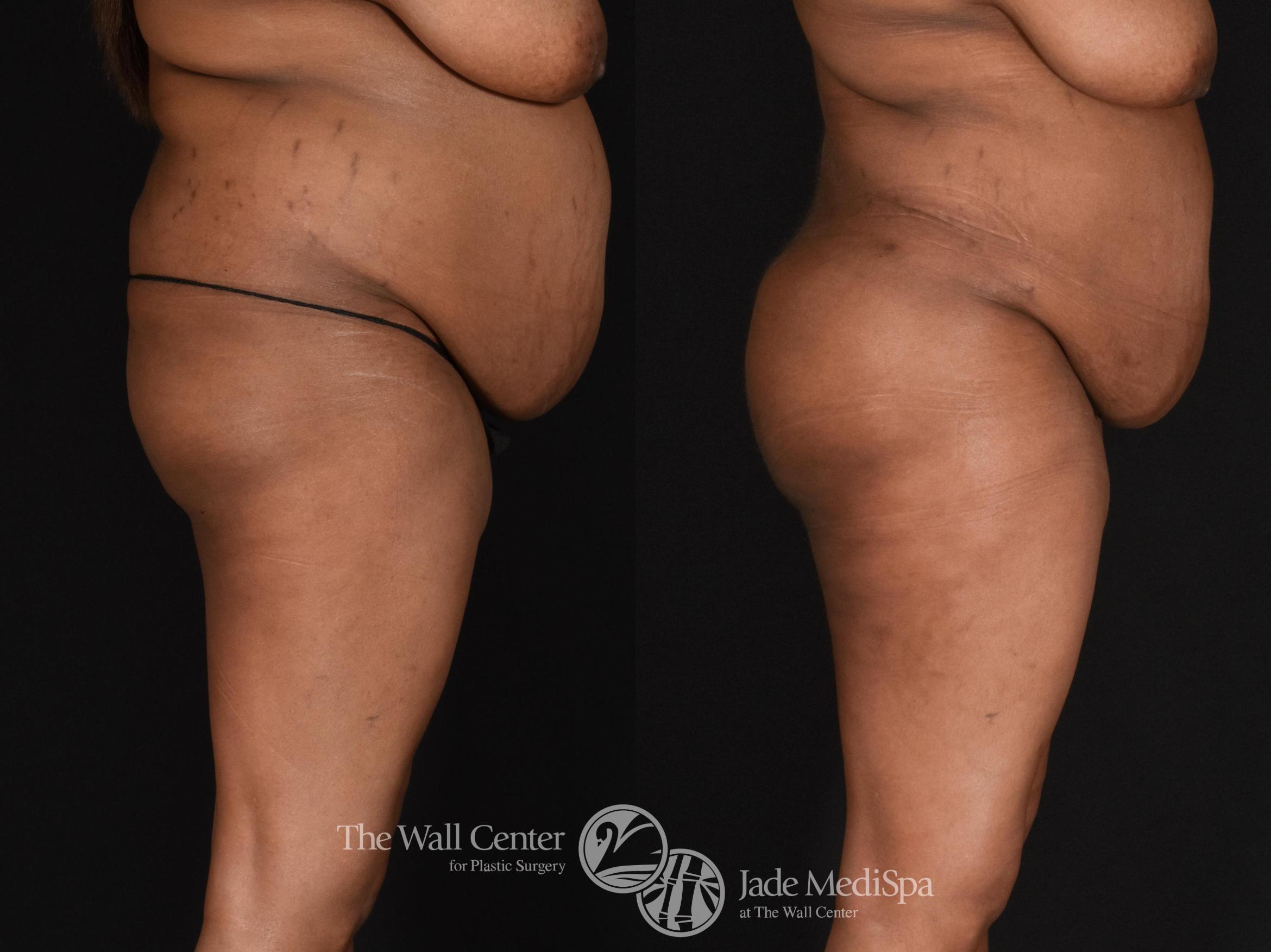 Before & After SAFELipo™ Case 598 View #3 View in Shreveport, LA