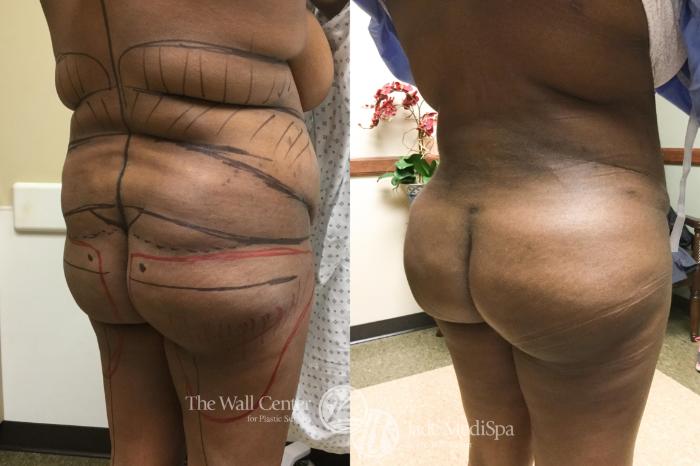 Before & After Buttock Augmentation Case 598 View #4 View in Shreveport, LA
