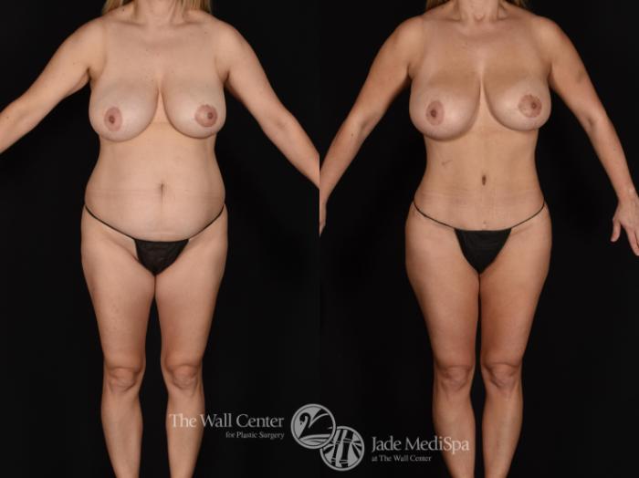 Before & After Tummy Tuck Case 640 VIEW #1 View in Shreveport, LA