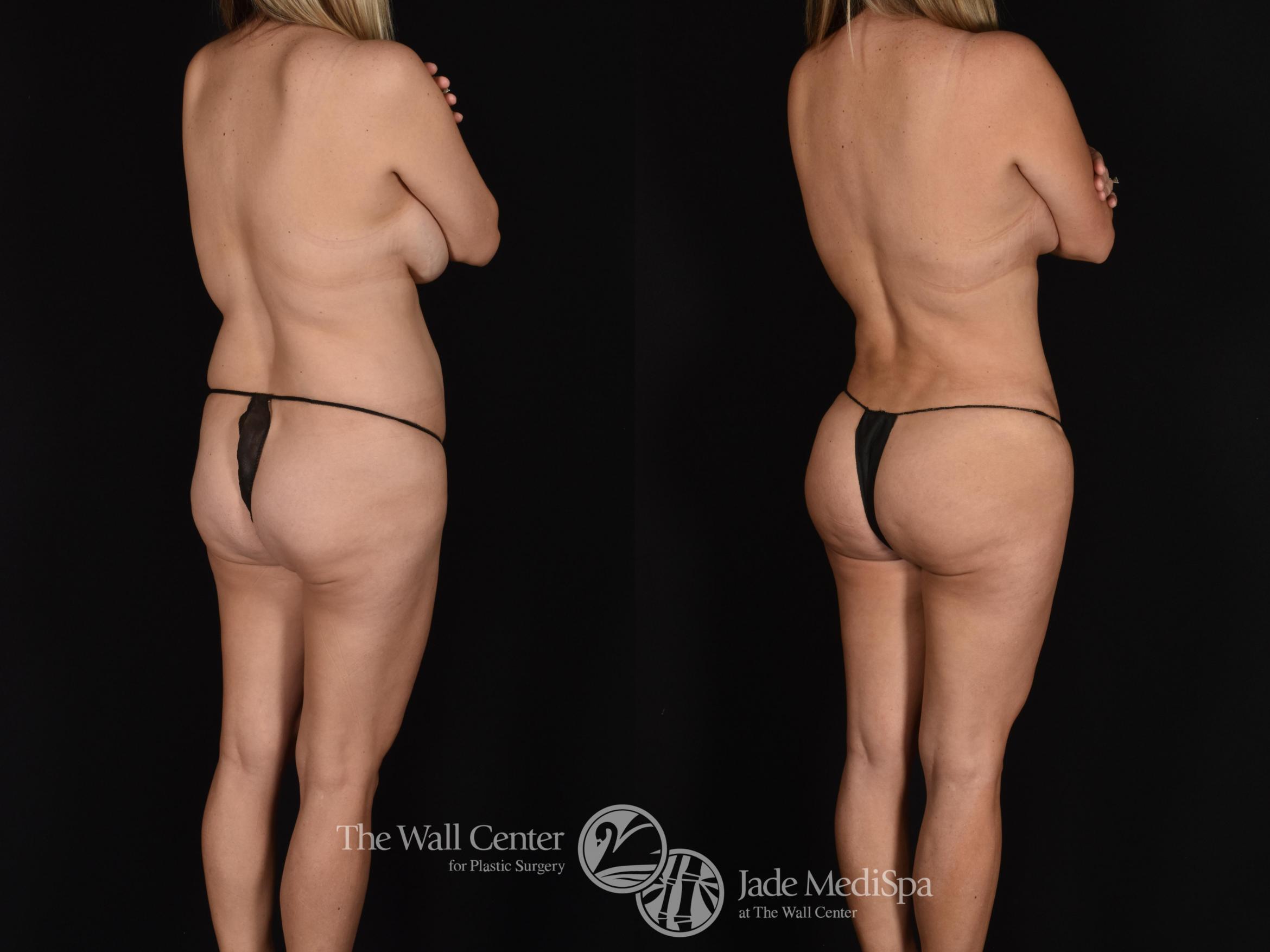 Before & After Fat Grafting – Buttocks Case 640 VIEW #3 View in Shreveport, LA