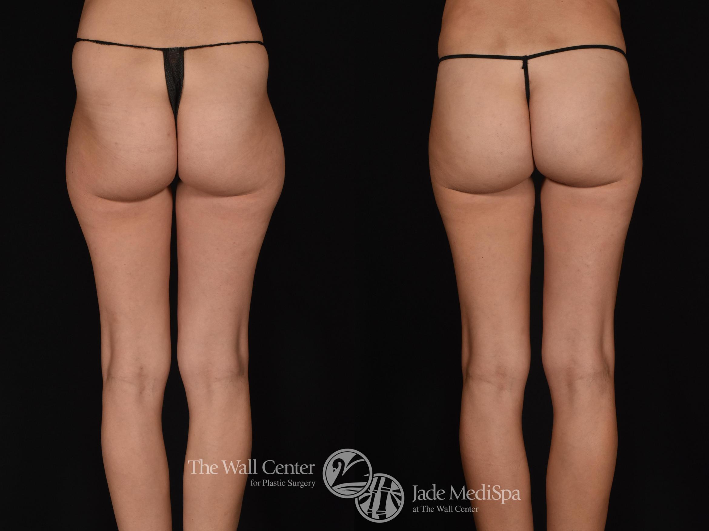 Before & After Fat Grafting – Buttocks Case 683 VIEW #2 View in Shreveport, LA