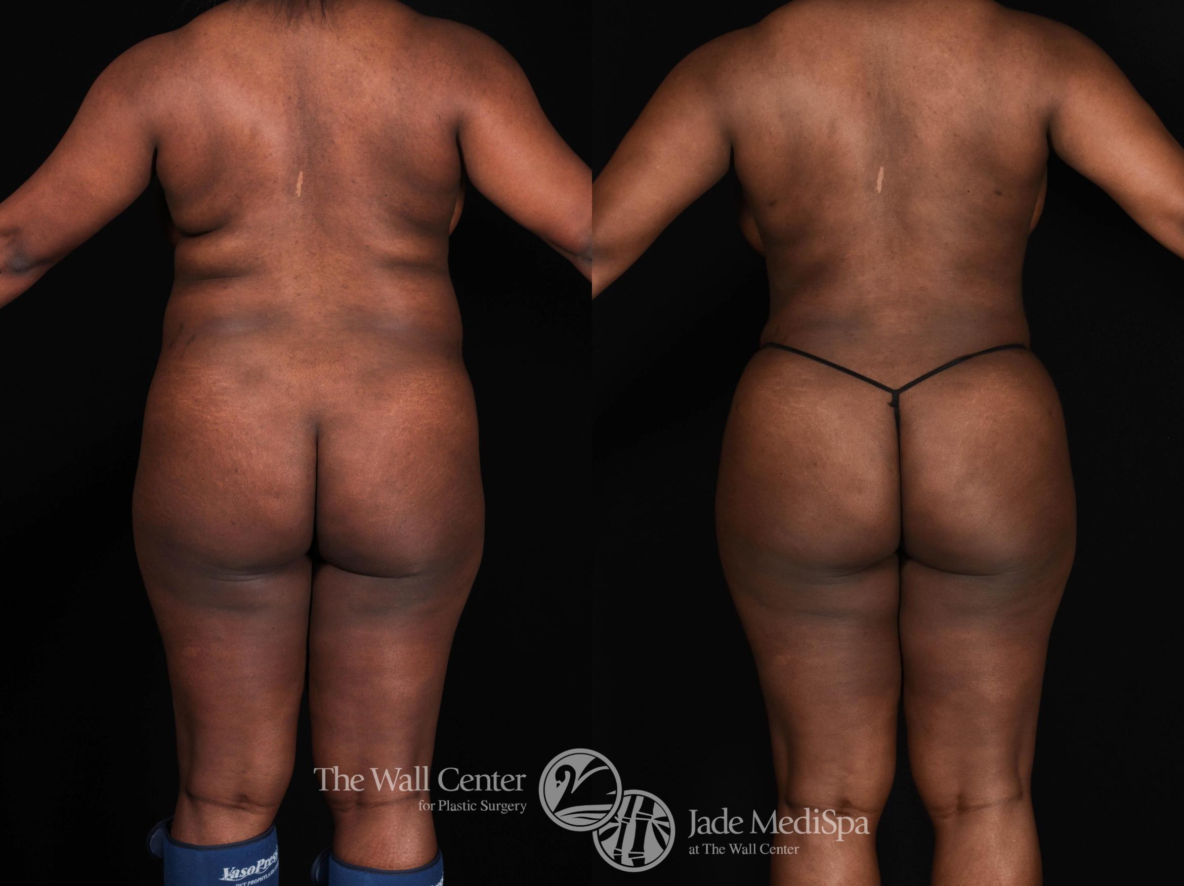 Before & After Fat Grafting – Buttocks Case 722 VIEW #1 View in Shreveport, LA