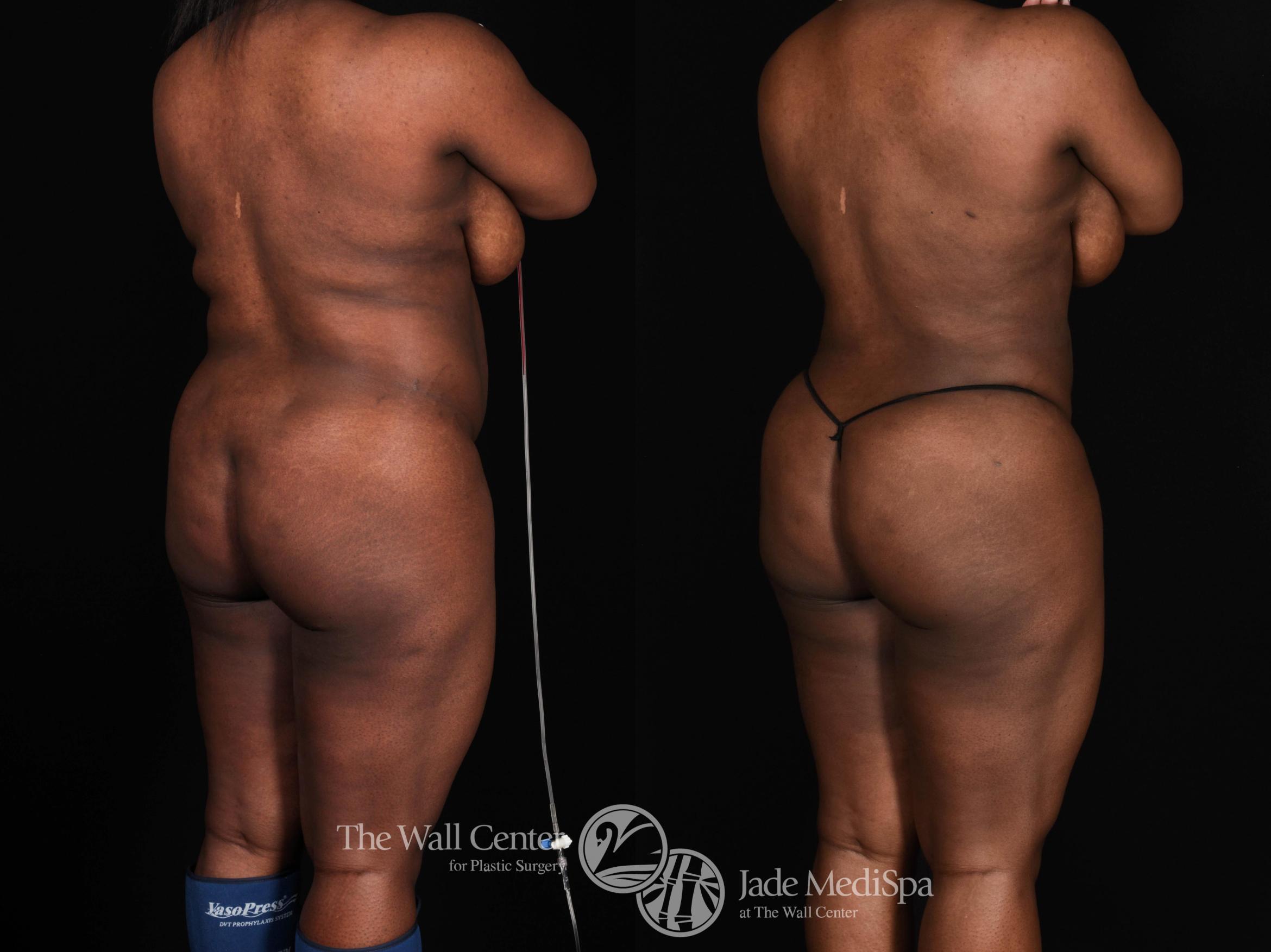 Before & After Fat Grafting – Buttocks Case 722 VIEW #2 View in Shreveport, LA
