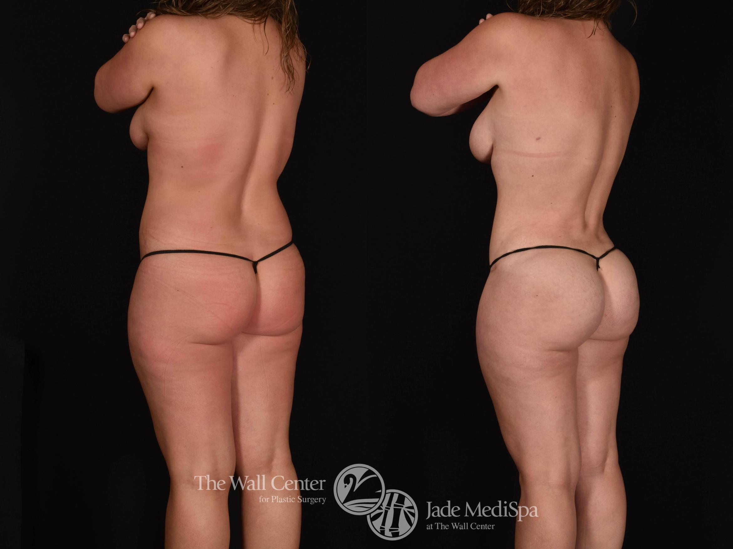 Before & After Buttock Augmentation Case 781 VIEW #1 View in Shreveport, LA