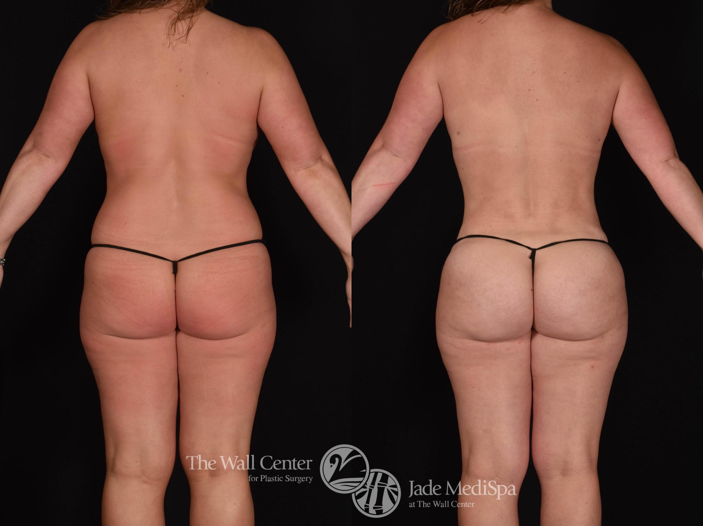 Before & After Buttock Augmentation Case 781 VIEW #2 View in Shreveport, LA