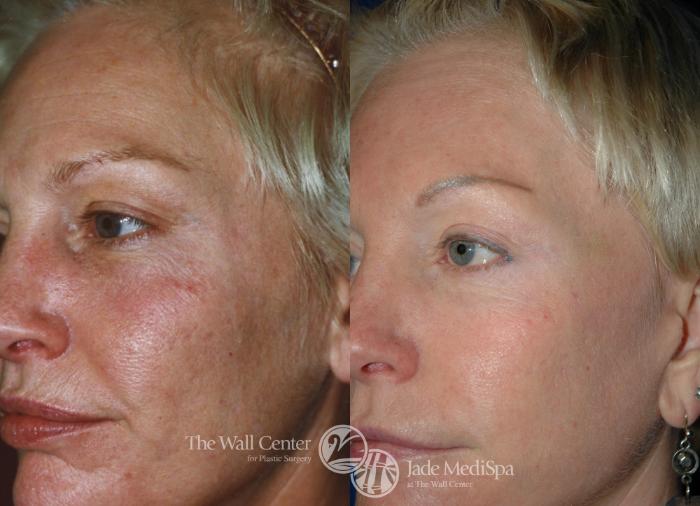 Before & After Fraxel Laser Skin Resurfacing Case 538 View #1 View in Shreveport, LA