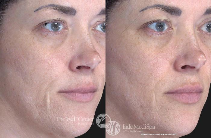 Before & After Fraxel Laser Skin Resurfacing Case 761 VIEW #1 View in Shreveport, LA