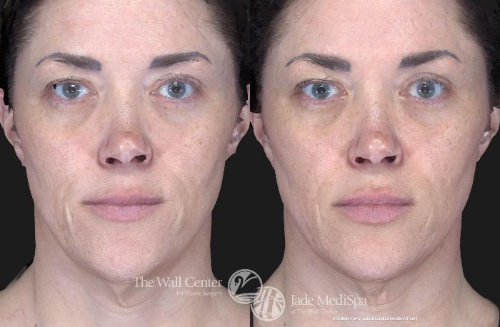 Before & After Fraxel Laser Skin Resurfacing Case 761 VIEW #2 View in Shreveport, LA