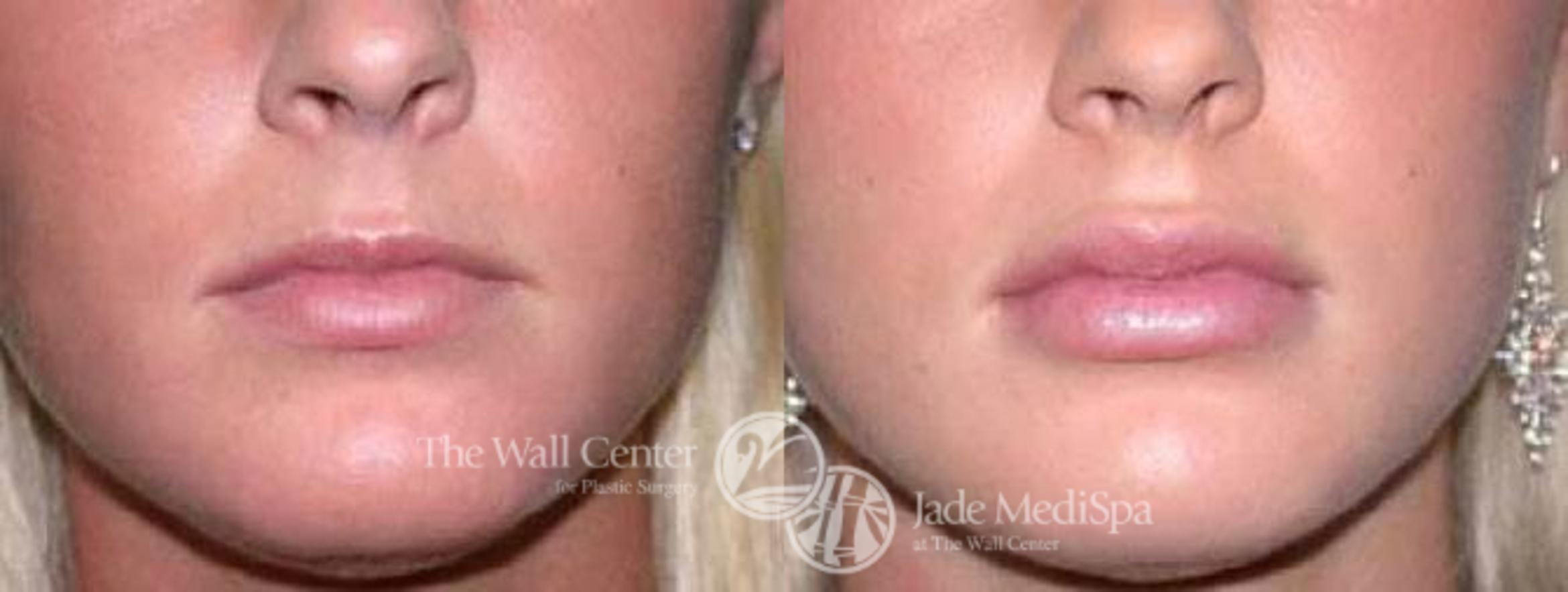 Before & After Lip Augmentation Case 88 View #1 View in Shreveport, LA