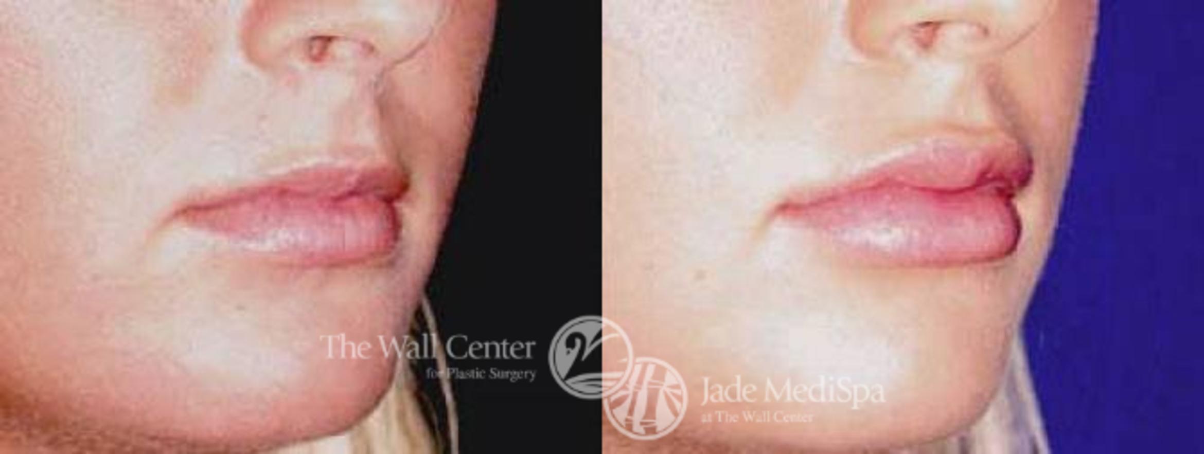 Before & After Lip Augmentation Case 88 View #2 View in Shreveport, LA