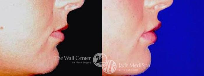 Before & After Lip Augmentation Case 88 View #3 View in Shreveport, LA