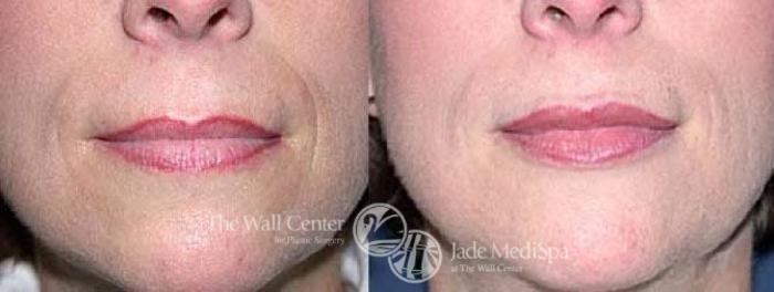 Before & After Lip Augmentation Case 89 View #1 View in Shreveport, LA