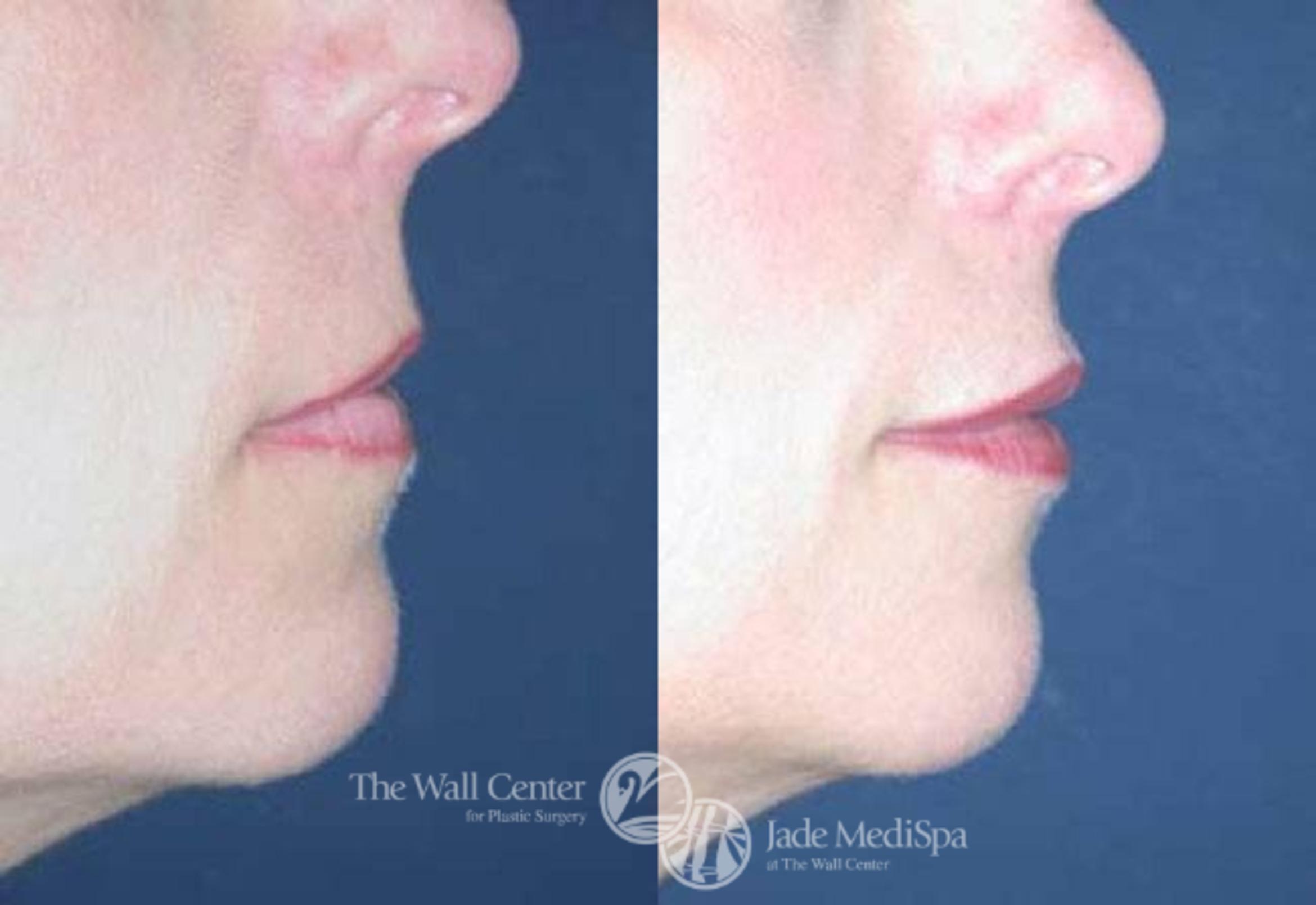 Before & After Lip Augmentation Case 89 View #2 View in Shreveport, LA