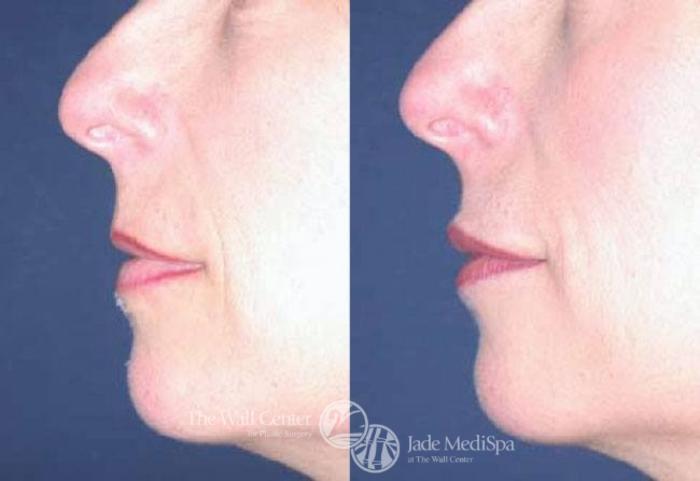 Before & After Lip Augmentation Case 89 View #3 View in Shreveport, LA