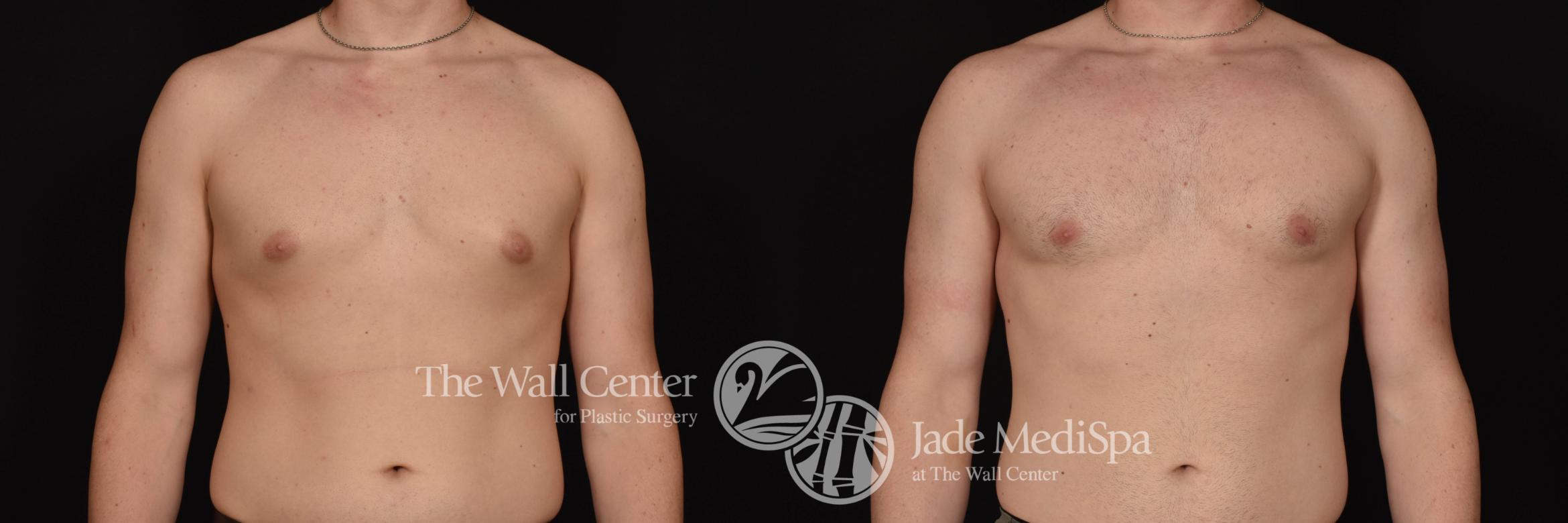 Before & After Male Breast Reduction Case 1026 Front View in Shreveport, LA