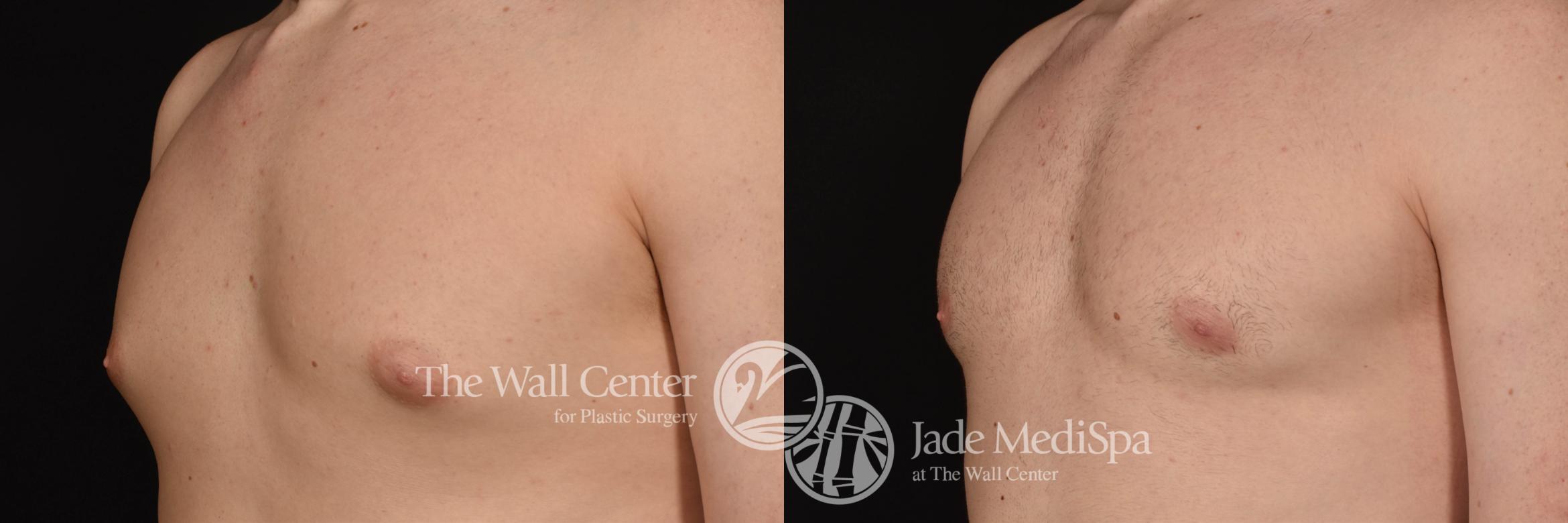 Before & After Male Chest Contouring Case 1026 Left Oblique View in Shreveport, LA
