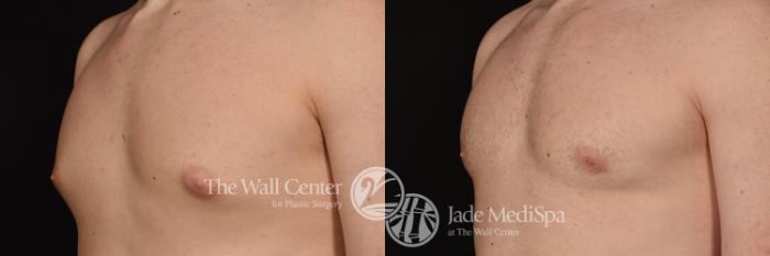 Before & After Male Chest Contouring Case 1026 Left Oblique View in Shreveport, LA