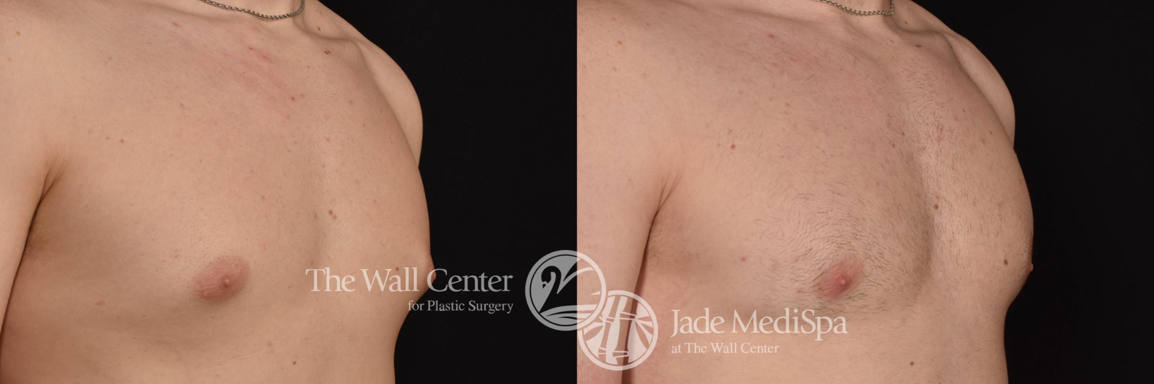 Before & After Male Chest Contouring Case 1026 Right Oblique View in Shreveport, LA