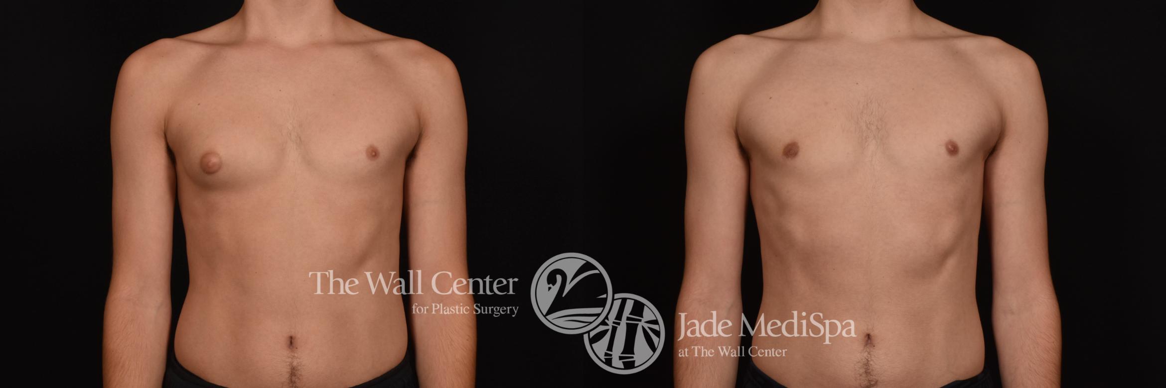 Before & After Male Breast Reduction Case 1031 Front View in Shreveport, LA