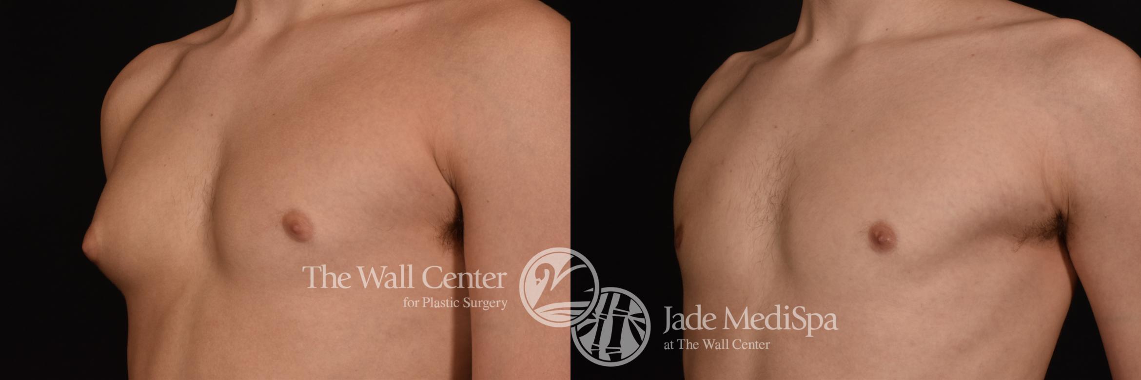 Before & After Male Chest Contouring Case 1031 Left Oblique View in Shreveport, LA