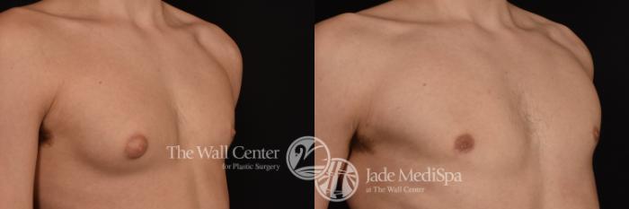 Before & After Male Chest Contouring Case 1031 Right Oblique View in Shreveport, LA