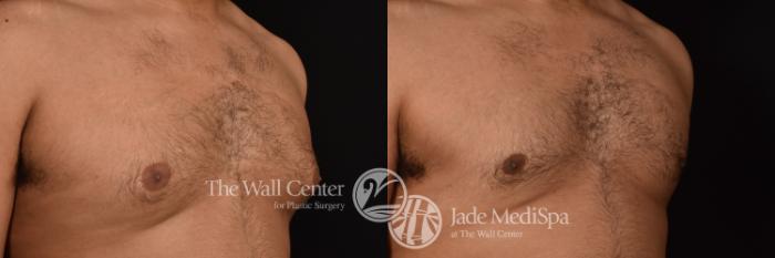 Before & After Male Breast Reduction Case 1108 Left Oblique View in Shreveport, LA