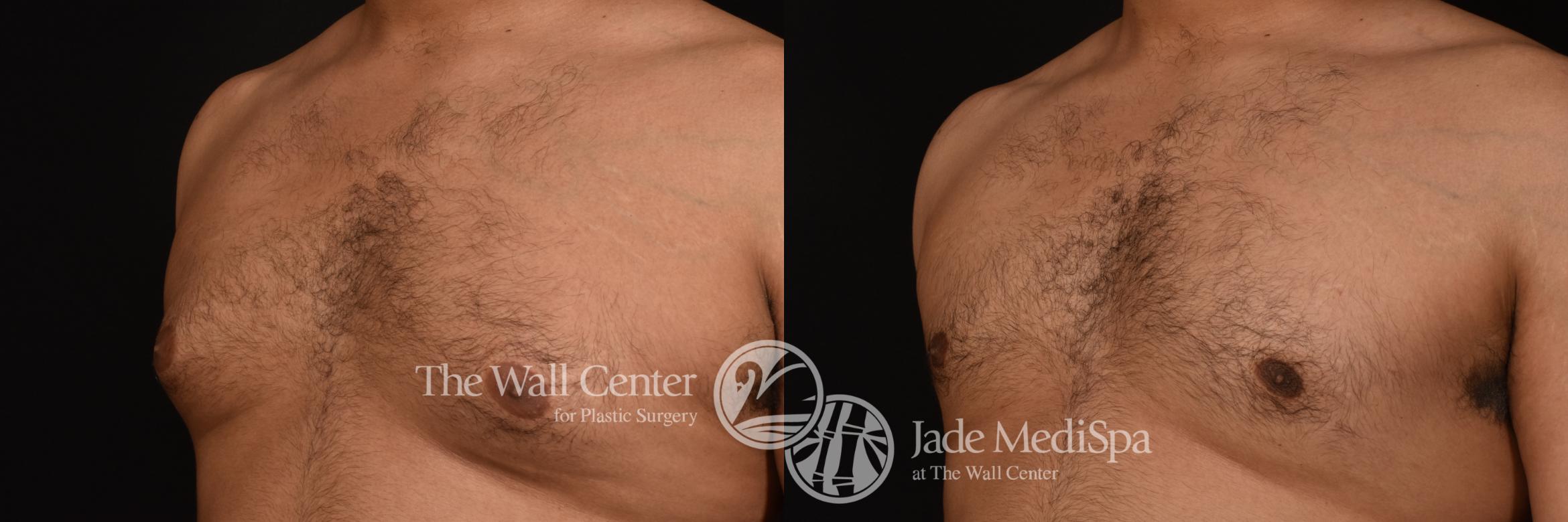 Before & After Male Breast Reduction Case 1108 Right Oblique View in Shreveport, LA