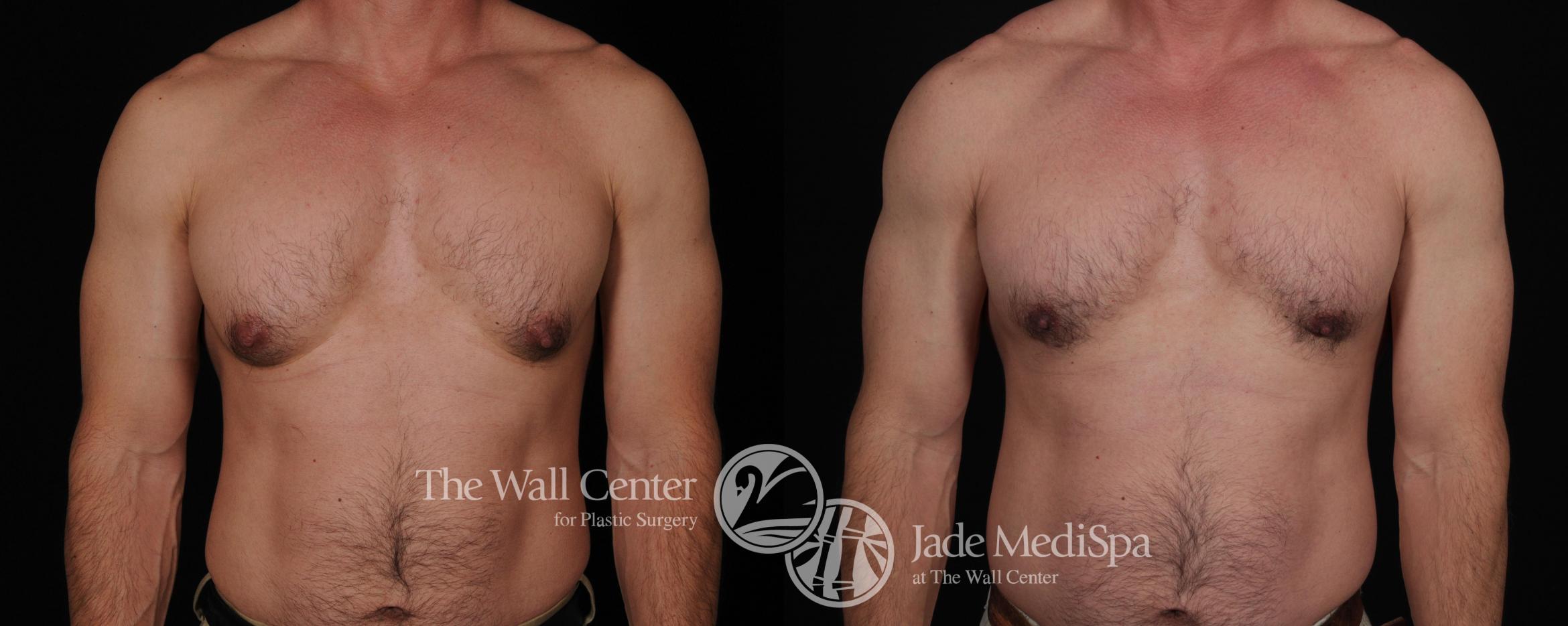 Before & After Male Breast Reduction Case 445 View #1 View in Shreveport, LA