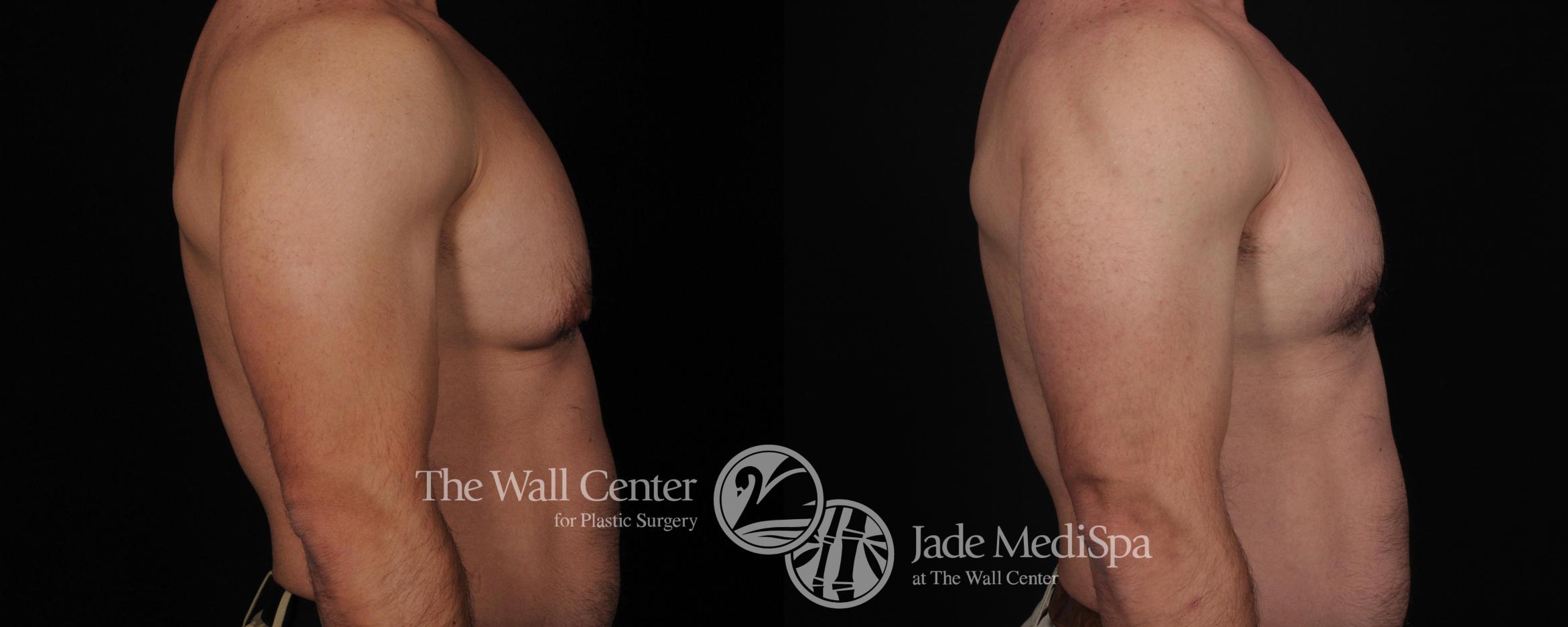 Before & After Male Breast Reduction Case 445 View #2 View in Shreveport, LA