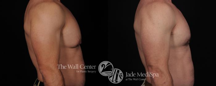 Before & After Male Breast Reduction Case 445 View #2 View in Shreveport, LA