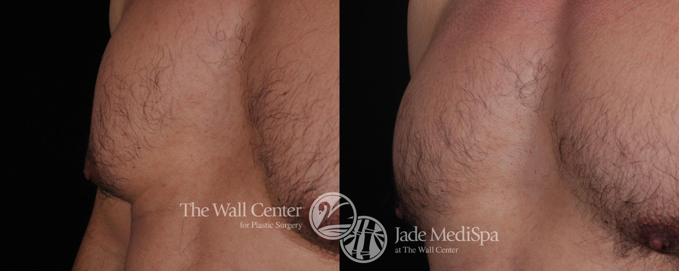 Before & After Male Breast Reduction Case 445 View #3 View in Shreveport, LA