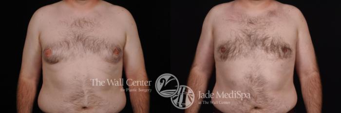 Before & After Male Breast Reduction Case 468 View #1 View in Shreveport, LA
