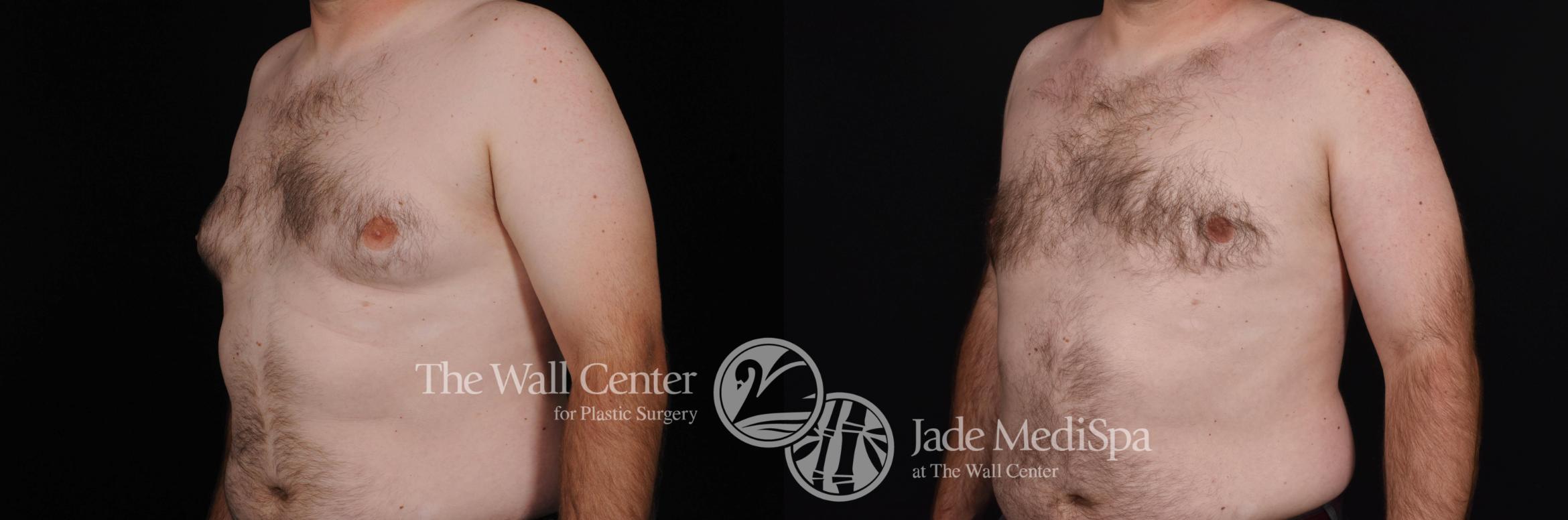 Before & After Male Breast Reduction Case 468 View #2 View in Shreveport, LA