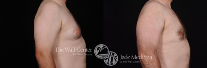 Before & After Male Breast Reduction Case 468 View #3 View in Shreveport, LA