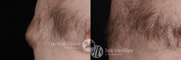 Before & After Male Breast Reduction Case 468 View #4 View in Shreveport, LA