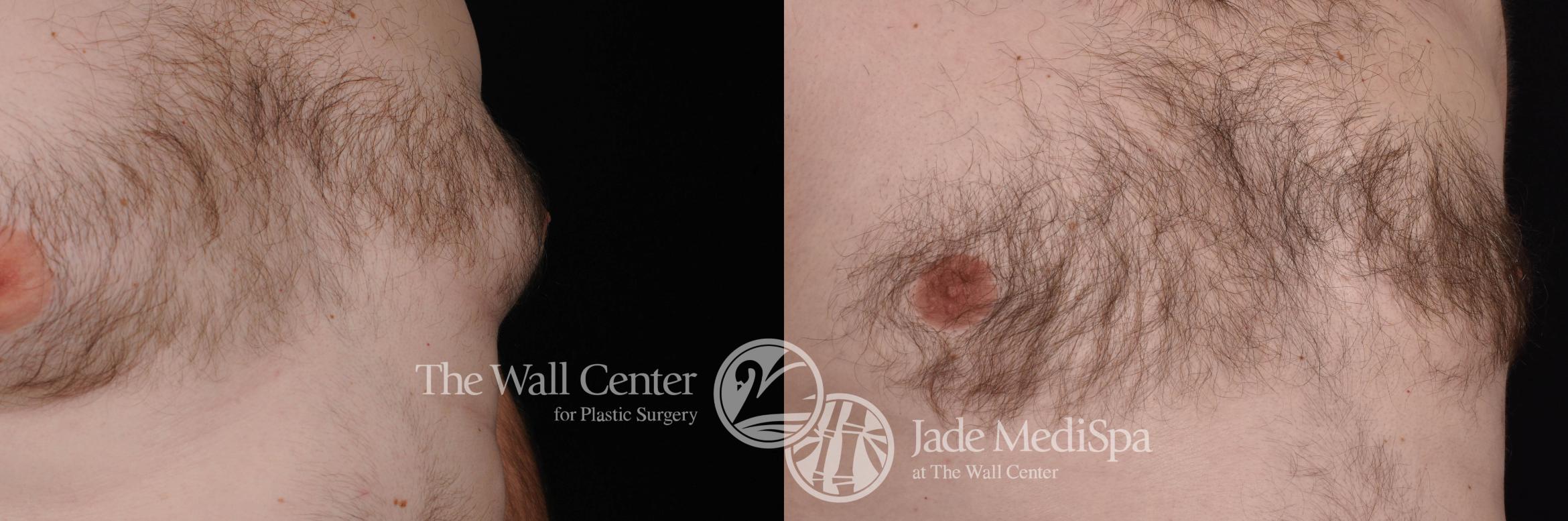 Before & After Male Breast Reduction Case 468 View #5 View in Shreveport, LA