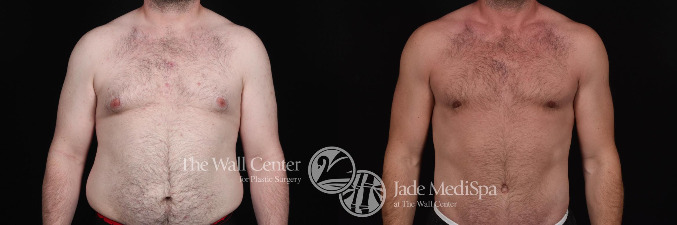 Male Breast Reduction Case 535 Before & After View #1 | Shreveport, LA | The Wall Center