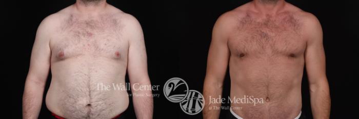 Before & After Male Breast Reduction Case 535 View #1 View in Shreveport, LA