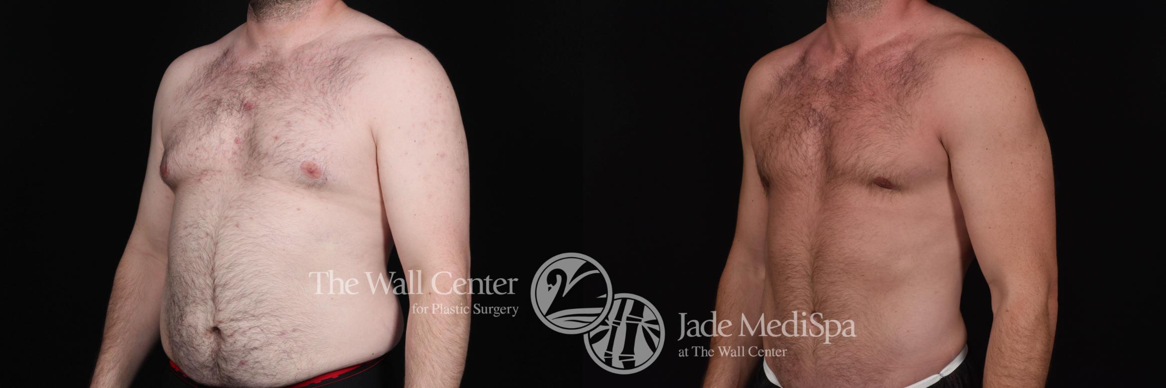 Before & After Male Breast Reduction Case 535 View #2 View in Shreveport, LA