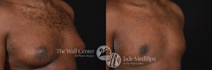 Before & After Male Breast Reduction Case 591 View #1 View in Shreveport, LA
