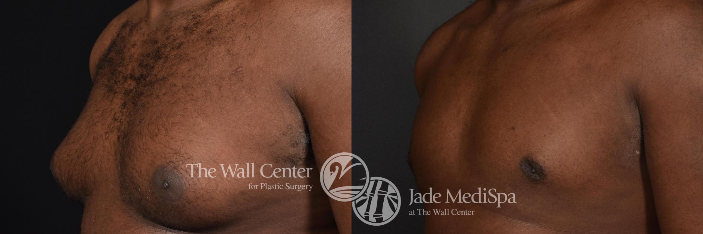 Before & After Male Breast Reduction Case 591 View #2 View in Shreveport, LA