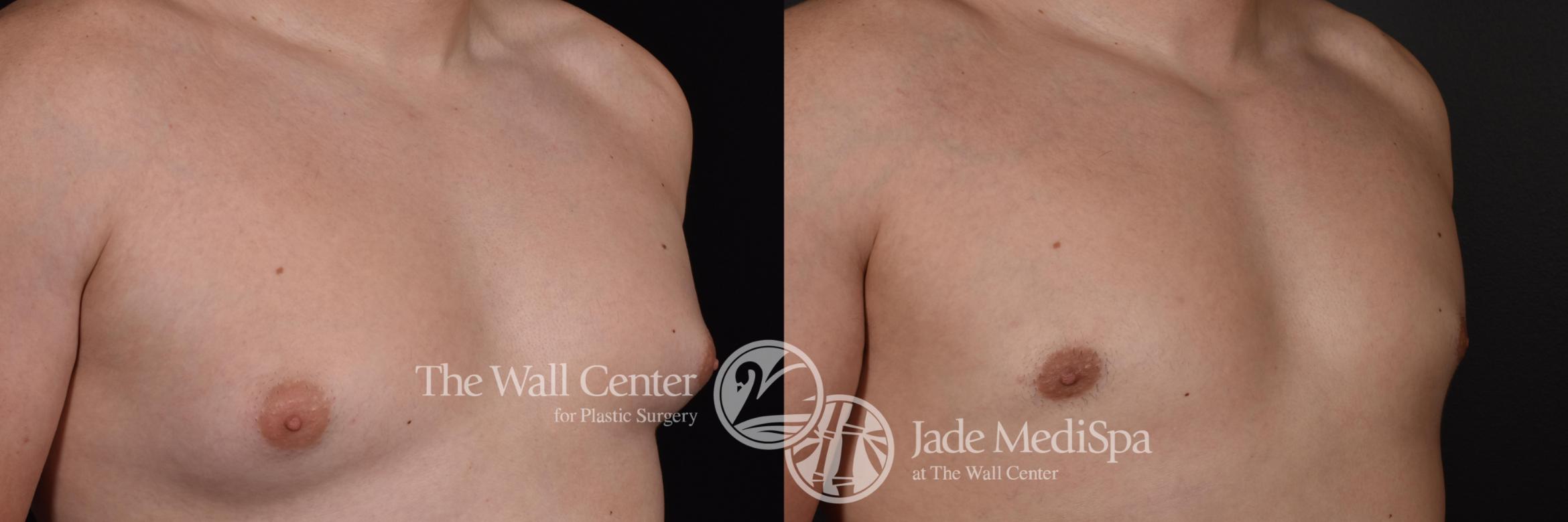 Before & After Male Breast Reduction Case 592 View #1 View in Shreveport, LA