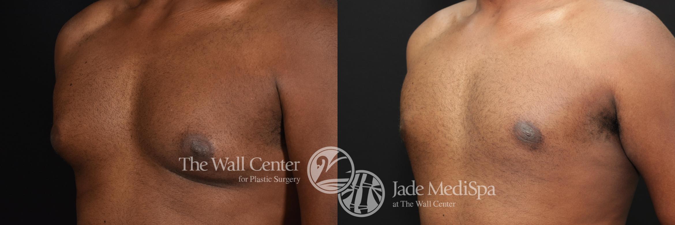 Before & After Male Breast Reduction Case 601 View #1 View in Shreveport, LA