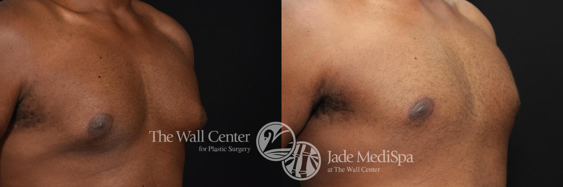 Before & After Male Breast Reduction Case 601 View #2 View in Shreveport, LA