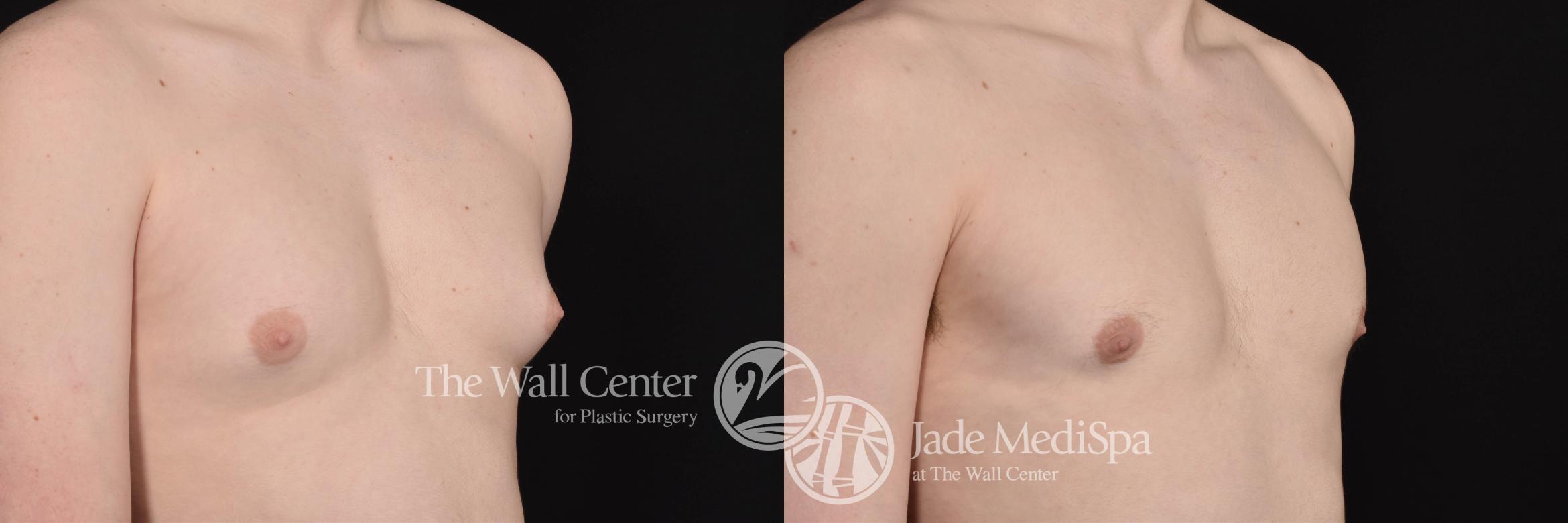Before & After Male Breast Reduction Case 687 VIEW #1 View in Shreveport, LA