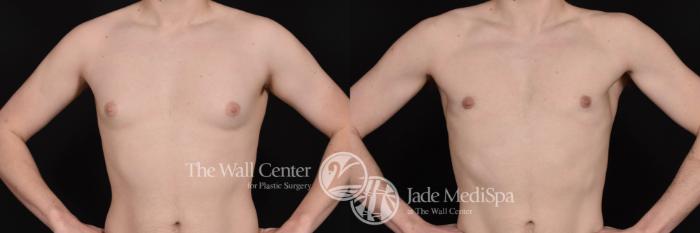 Before & After Male Breast Reduction Case 687 VIEW #2 View in Shreveport, LA