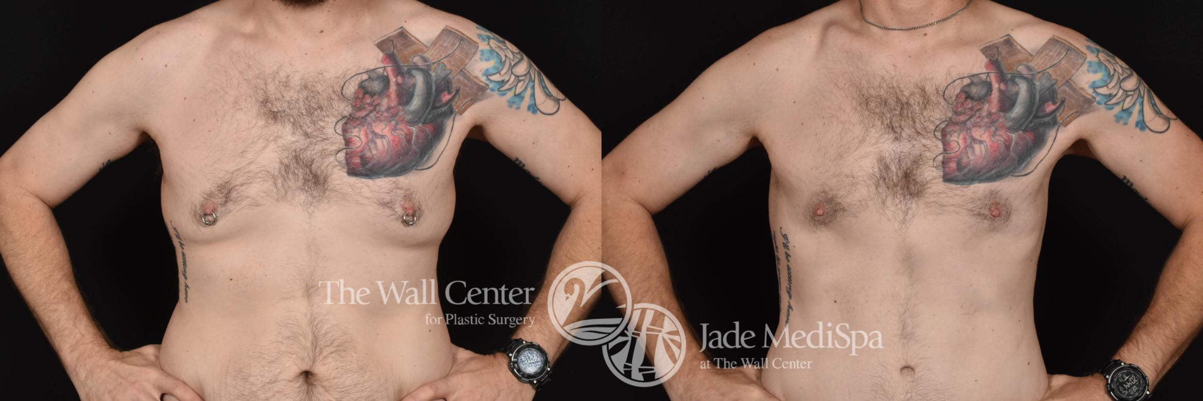 Before & After Male Breast Reduction Case 765 VIEW #1 View in Shreveport, LA