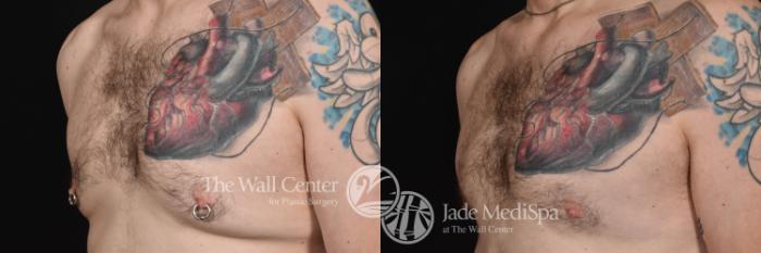 Before & After Male Breast Reduction Case 765 VIEW #2 View in Shreveport, LA