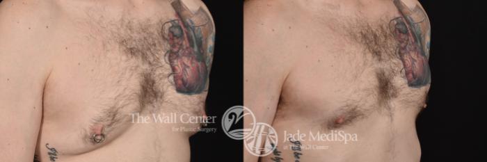 Before & After Male Breast Reduction Case 765 VIEW #3 View in Shreveport, LA