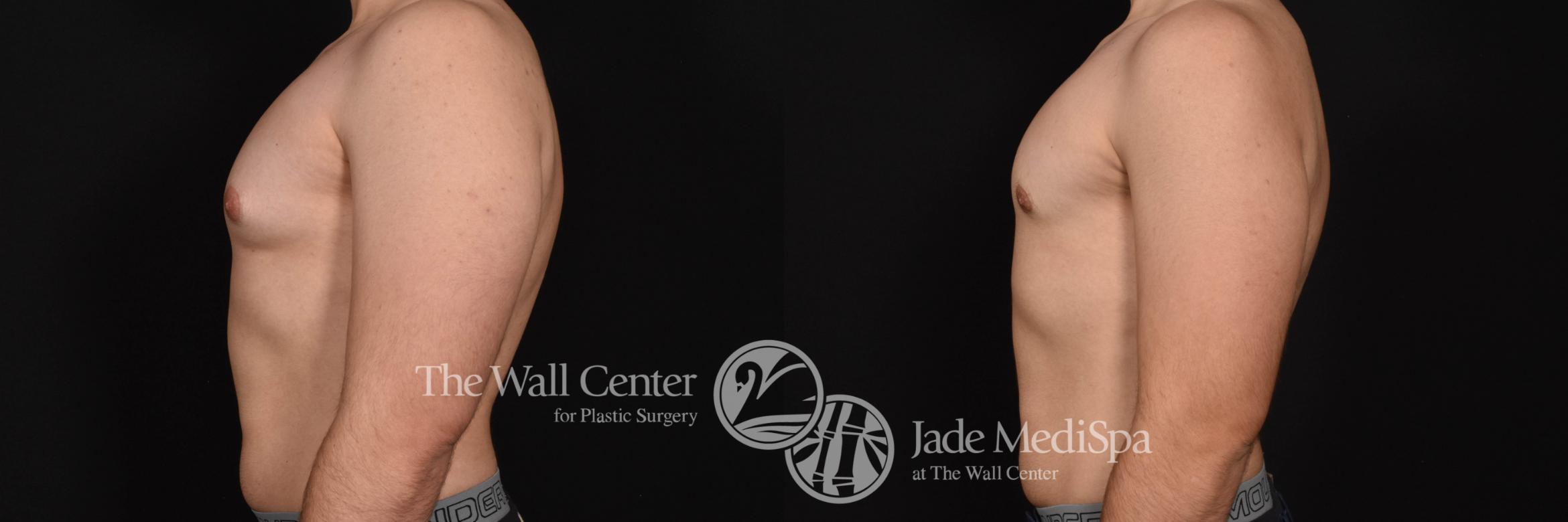 Gynecomastia Left Side Photo, Shreveport, Louisiana, The Wall Center for Plastic Surgery, Case 807